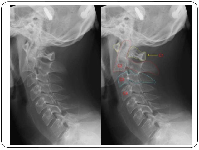 Fracture types - Plaster Of Paris tecniques and Complications