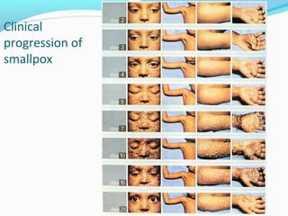 Clinical
progression of
smallpox

 