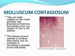 MOLLUSCUM CONTAGIOSUM
They are most

common on the trunk,
genitalia, and
proximal extremities
and usually occur in a
cluster of five to 20
nodules.

The disease is more

common in children
than adults, but its
incidence is
increasing in sexually
active individuals.

 