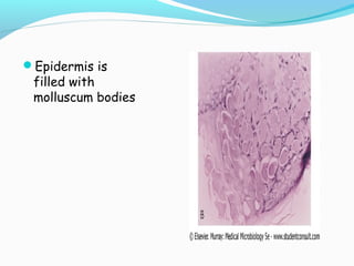 Epidermis is

filled with
molluscum bodies

 