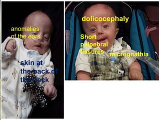 dolicocephaly
anomalies
of the ears

skin at
the back of
the neck

Short
palpebral
fissures micrognathia

 