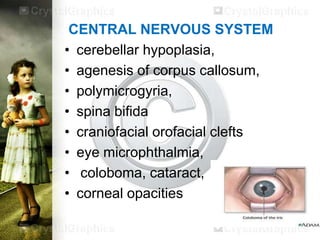 CENTRAL NERVOUS SYSTEM
• cerebellar hypoplasia,
• agenesis of corpus callosum,
• polymicrogyria,
• spina bifida
• craniofacial orofacial clefts
• eye microphthalmia,
• coloboma, cataract,
• corneal opacities

 