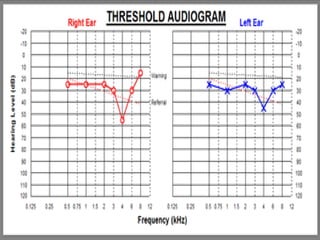 Hearing Loss