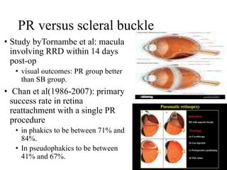 PR versus scleral buckle
• Study byTornambe et al: macula
involving RRD within 14 days
post-op
• visual outcomes: PR group better
than SB group.
• Chan et al(1986-2007): primary
success rate in retina
reattachment with a single PR
procedure
• in phakics to be between 71% and
84%.
• In pseudophakics to be between
41% and 67%.
 