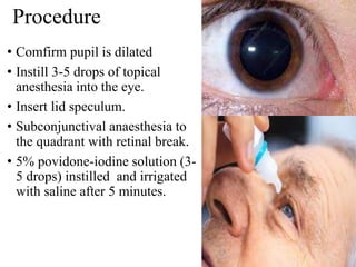 Procedure
• Comfirm pupil is dilated
• Instill 3-5 drops of topical
anesthesia into the eye.
• Insert lid speculum.
• Subconjunctival anaesthesia to
the quadrant with retinal break.
• 5% povidone-iodine solution (3-
5 drops) instilled and irrigated
with saline after 5 minutes.
 