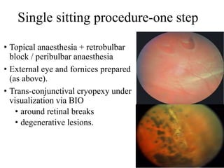 Single sitting procedure-one step
• Topical anaesthesia + retrobulbar
block / peribulbar anaesthesia
• External eye and fornices prepared
(as above).
• Trans-conjunctival cryopexy under
visualization via BIO
• around retinal breaks
• degenerative lesions.
 