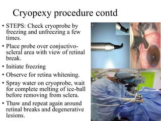 Cryopexy procedure contd
• STEPS: Check cryoprobe by
freezing and unfreezing a few
times.
• Place probe over conjuctivo-
scleral area with view of retinal
break.
• Initiate freezing
• Observe for retina whitening.
• Spray water on cryoprobe, wait
for complete melting of ice-ball
before removing from sclera.
• Thaw and repeat again around
retinal breaks and degenerative
lesions.
 