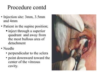 Procedure contd
• Injection site: 3mm, 3.5mm
and 4mm
• Patient in the supine position;
 inject through a superior
quadrant and away from
the most bullous area of
detachment
• Needle
• perpendicular to the sclera
• point downward toward the
center of the vitreous
cavity.
 