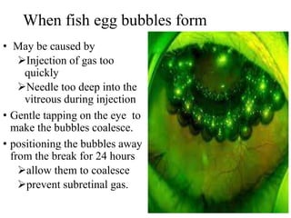 When fish egg bubbles form
• May be caused by
Injection of gas too
quickly
Needle too deep into the
vitreous during injection
• Gentle tapping on the eye to
make the bubbles coalesce.
• positioning the bubbles away
from the break for 24 hours
allow them to coalesce
prevent subretinal gas.
 