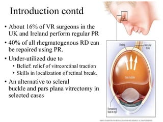 Introduction contd
• About 16% of VR surgeons in the
UK and Ireland perform regular PR.
• 40% of all rhegmatogenous RD can
be repaired using PR.
• Under-utilized due to
• Belief: relief of vitreoretinal traction
• Skills in localization of retinal break.
• An alternative to scleral
buckle and pars plana vitrectomy in
selected cases
 