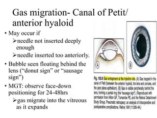 Gas migration- Canal of Petit/
anterior hyaloid
• May occur if
needle not inserted deeply
enough
needle inserted too anteriorly.
• Bubble seen floating behind the
lens (“donut sign” or “sausage
sign”)
• MGT: observe face-down
positioning for 24-48hrs
gas migrate into the vitreous
as it expands
 