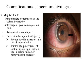 Complications-subconjunctival gas
• May be due to
incomplete penetration of the
sclera by needle
leakage of gas from injection
site.
• Treatment is not required.
• Prevent subconjunctival gas by
 Proper needle insertion into
the vitreous cavity
 Immediate placement of
cotton-tipped applicator on
the injection site after
removal of the needle.
 