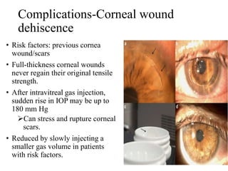 Complications-Corneal wound
dehiscence
• Risk factors: previous cornea
wound/scars
• Full-thickness corneal wounds
never regain their original tensile
strength.
• After intravitreal gas injection,
sudden rise in IOP may be up to
180 mm Hg
Can stress and rupture corneal
scars.
• Reduced by slowly injecting a
smaller gas volume in patients
with risk factors.
 