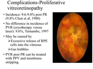 Complications-Proliferative
vitreoretinopathy
• Incidence: 9.6-9.8% post PR
(9.8% Chen et al, 1988)
• No difference in incidence of
PVR (cryotherapy versus
laser): 9.6%, Tornambe, 1997.
• May be caused by
Excessive release of RPE
cells into the vitreous
Gas bubbles
• PVR post PR can be treated
with PPV and membrane
stripping.
 