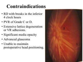 Contraindications
• RD with breaks in the inferior
4 clock hours
• PVR of Grade C or D.
• Extensive lattice degeneration
or VR adhesions.
• Significant media opacity
• Advanced glaucoma
• Unable to maintain
postoperative head positioning.
 