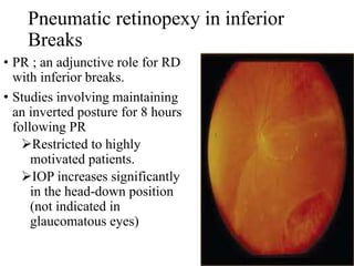 Pneumatic retinopexy in inferior
Breaks
• PR ; an adjunctive role for RD
with inferior breaks.
• Studies involving maintaining
an inverted posture for 8 hours
following PR
Restricted to highly
motivated patients.
IOP increases significantly
in the head-down position
(not indicated in
glaucomatous eyes)
 