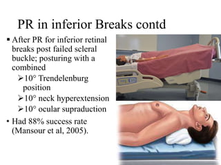 PR in inferior Breaks contd
 After PR for inferior retinal
breaks post failed scleral
buckle; posturing with a
combined
10° Trendelenburg
position
10° neck hyperextension
10° ocular supraduction
• Had 88% success rate
(Mansour et al, 2005).
 