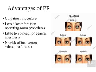 Advantages of PR
• Outpatient procedure
• Less discomfort than
operating room procedures
• Little to no need for general
anesthesia
• No risk of inadvertent
scleral perforation
 