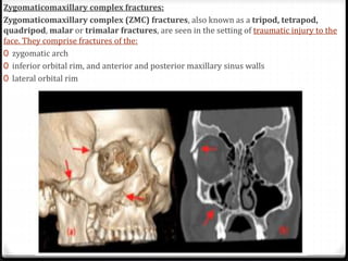 Facial fracture | PPT