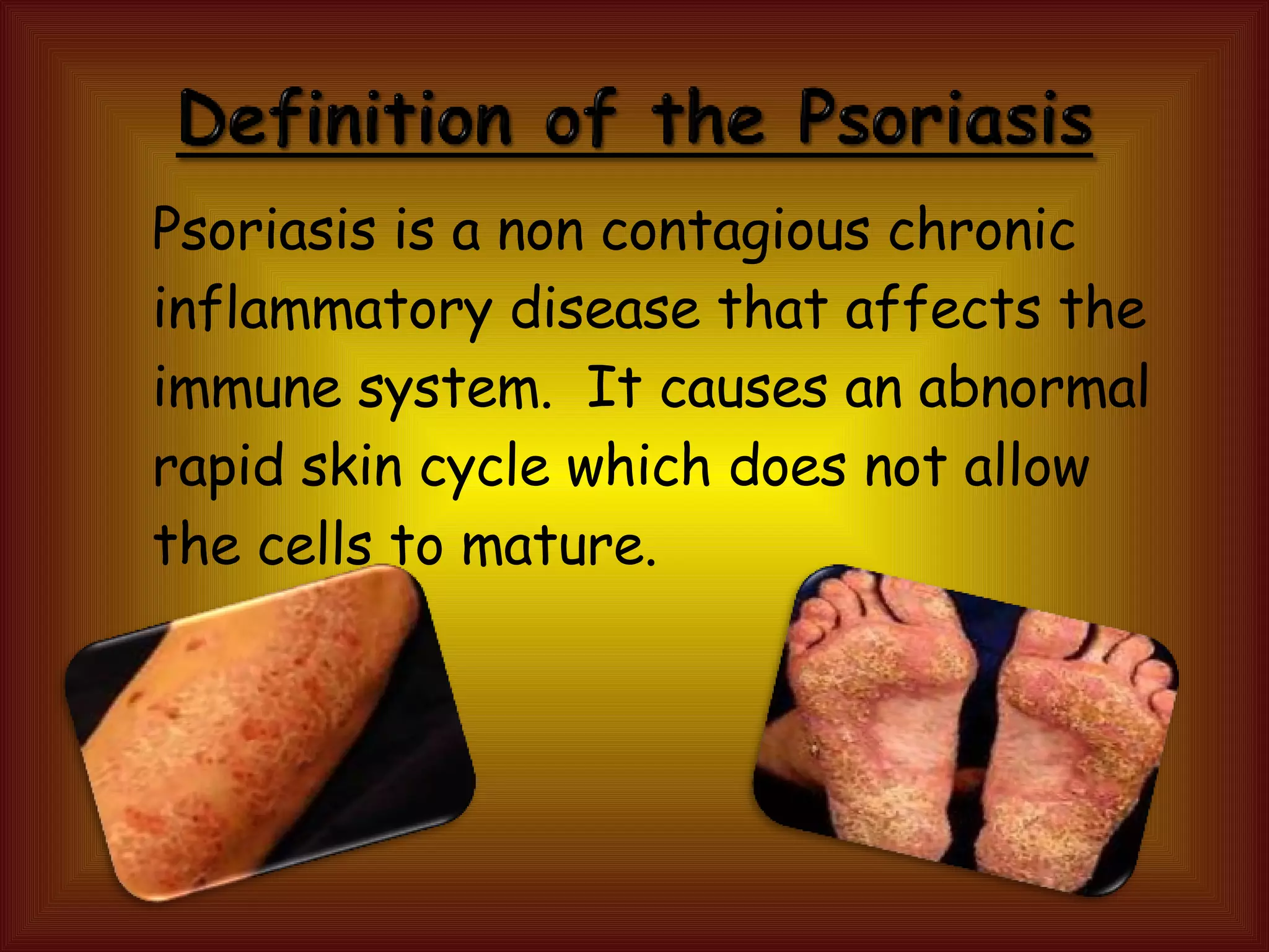 Psoriasis | PPT