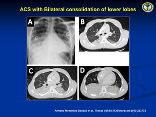 Pulmonary Complications of Sickle Cell Disease. pptx | PPT