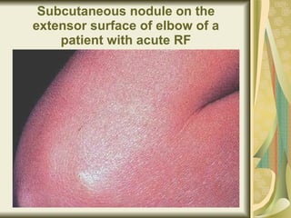 Subcutaneous nodule on the extensor surface of elbow of a patient with acute RF 