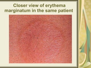 Closer view of erythema marginatum in the same patient   