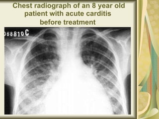 Chest radiograph of an 8 year old patient with acute carditis  before treatment   