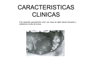 CARACTERISTICAS
CLINICAS
 Se desarrolla generalmente como una masa de tejido blando fluctuante y
unilateral en el piso de la boca
 