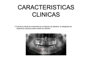 CARACTERISTICAS
CLINICAS
 Cuando la ránula es ocasionada por el bloqueo de sialolitos, la radiografía (en
especial la oclusiva) puede revelar los cálculos.
 