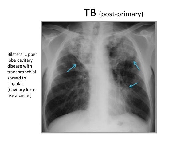 Reading chest X-ray