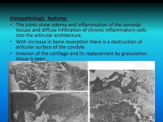 Histopathologic features:
• The joints show edema and inflammation of the synovial
tissues and diffuse infiltration of chronic inflammatory cells
into the articular architecture.
• With increase in bone resorption there is a destruction of
articular surface of the condyle.
• Invasion of the cartilage and its replacement by granulation
tissue is seen.
 