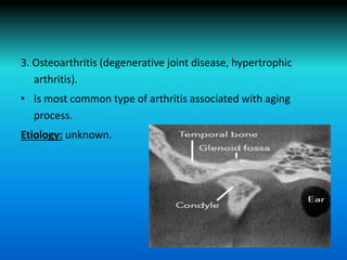 3. Osteoarthritis (degenerative joint disease, hypertrophic
arthritis).
• Is most common type of arthritis associated with aging
process.
Etiology: unknown.
 