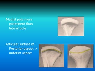 Medial pole more
prominent than
lateral pole
Articular surface of
Posterior aspect >
anterior aspect
 