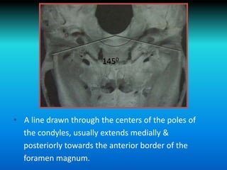 • A line drawn through the centers of the poles of
the condyles, usually extends medially &
posteriorly towards the anterior border of the
foramen magnum.
1450
 