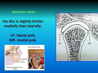 Anterior view –
the disc is slightly thicker
medially than laterally.
LP- lateral pole
MP- medial pole
 