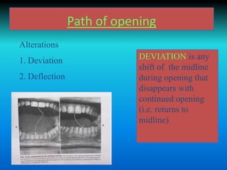 Path of opening
Alterations
1. Deviation
2. Deflection
DEVIATION is any
shift of the midline
during opening that
disappears with
continued opening
(i.e. returns to
midline)
 