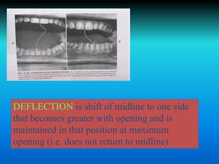 DEFLECTION is shift of midline to one side
that becomes greater with opening and is
maintained in that position at maximum
opening (i.e. does not return to midline)
 