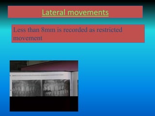 Lateral movements
Less than 8mm is recorded as restricted
movement
 