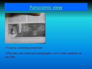 Panoramic view
Used as screening projection
Provides non corrected tomographic view of the condyles on
one film
 