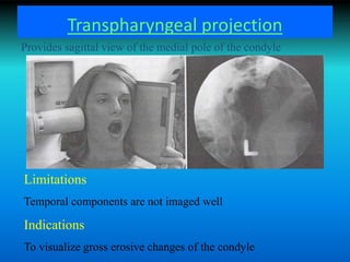 Transpharyngeal projection
Limitations
Temporal components are not imaged well
Indications
To visualize gross erosive changes of the condyle
Provides sagittal view of the medial pole of the condyle
 