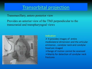 Transorbital projection
Transmaxillary, antero posterior view
Provides an anterior view of the TMJ perpendicular to the
transcranial and transpharyngeal views
Indication
 It provides images of entire
mediolateral dimension and the articular
eminence , condylar neck and condylar
head are imaged
Range of motion cannot be assessed
Mainly for detection of condylar neck
fractures
 