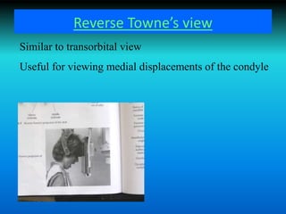 Reverse Towne’s view
Similar to transorbital view
Useful for viewing medial displacements of the condyle
 