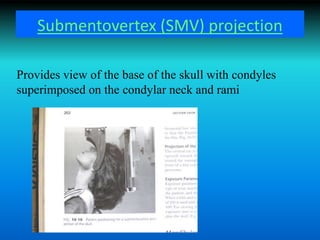 Submentovertex (SMV) projection
Provides view of the base of the skull with condyles
superimposed on the condylar neck and rami
 