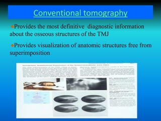 Conventional tomography
Provides the most definitive diagnostic information
about the osseous structures of the TMJ
Provides visualization of anatomic structures free from
superimposition
 