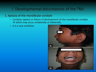 I. Developmental disturbances of the TMJ
1. Aplasia of the mandibular condyle
– Condylar aplasia or failure of development of the mandibular condyle
 which may occur unilaterally or bilaterally.
– It is a rare condition
 