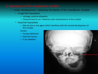 2. Hypoplasia of the mandibular condyle
– Under development / defective formation of the mandibular condyle
• Congenital hypoplasia
– etiology could be Idiopathic
– Characterized by uni / bilateral under-development of the condyle
• Acquired hypoplasia
– May be due to any agent which interferes with the normal development of
the condyle.
Causes:
– Forceps deliveries
– External trauma
– X-ray radiation
 