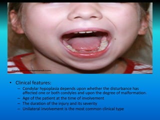 • Clinical features:
– Condylar hypoplasia depends upon whether the disturbance has
affected one or both condyles and upon the degree of malformation.
– Age of the patient at the time of involvement
– The duration of the injury and its severity
– Unilateral involvement is the most common clinical type
 