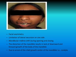 – Facial asymmetry
– Limitation of lateral excursion on one side
– Mandibular midline shift during opening and closing
– The distortion of the mandible results in lack of downward and
forward growth of the body of the mandible
– Due to arrest of the chief growth center of the mandible i.e., condyle.
 