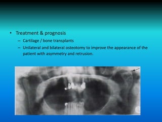 • Treatment & prognosis
– Cartilage / bone transplants
– Unilateral and bilateral osteotomy to improve the appearance of the
patient with asymmetry and retrusion.
 